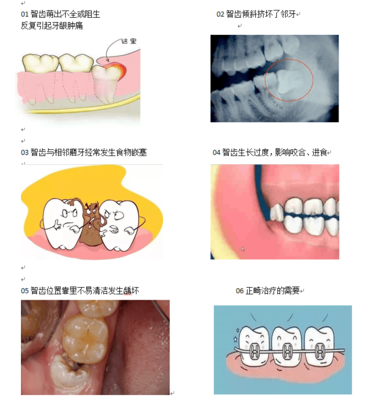 智齿拔牙疼吗