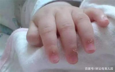 宝宝手起倒刺是缺什么