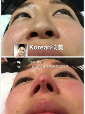 纳米隆鼻多少钱