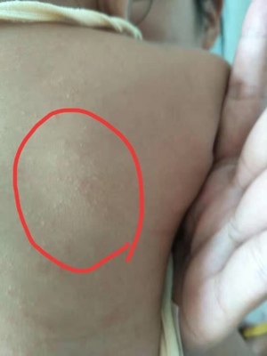 后背受潮起痘痘