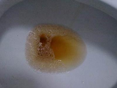 小便茶色是怎么回事