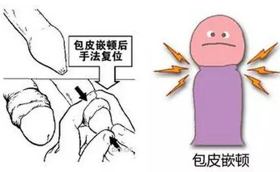 包皮浮肿是怎么回事