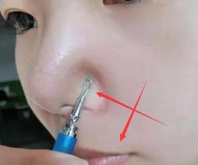 女生鼻子长痘痘怎么办