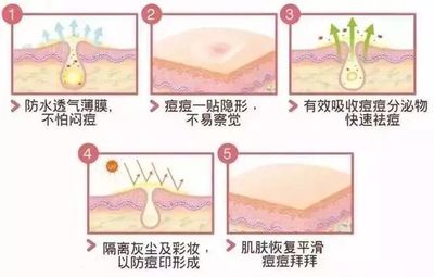 痘痘和粉刺怎么区分