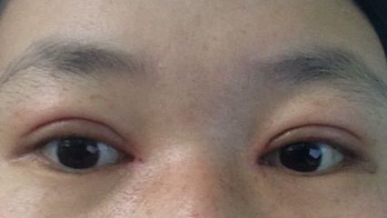 割完双眼皮睁眼运动