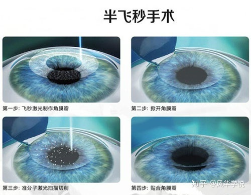 眼睛极光手术多少钱