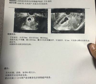 宫颈息肉会影响胎儿吗