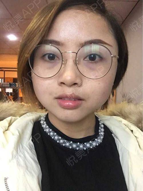 痘痘肌可以光子嫩肤吗