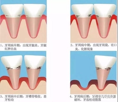 牙缝大怎么治疗