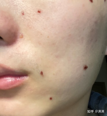 点痣以后怎么快速恢复