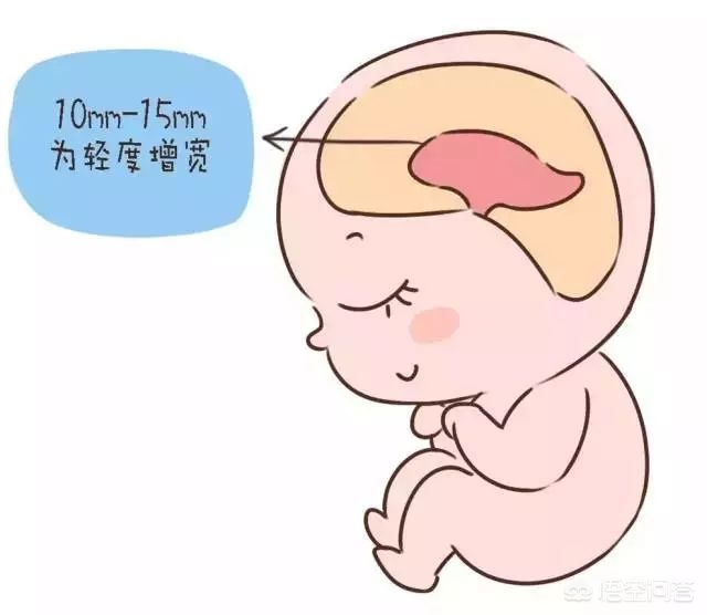 胎儿头小会影响智力吗