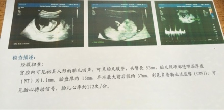胎儿心跳是什么声音