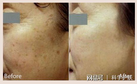 脸上的痘痘有什么分类