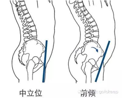 骨盆前倾肚子大