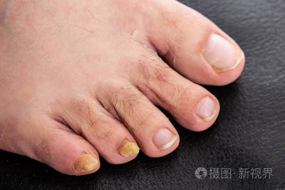 脚趾甲增厚是怎么回事