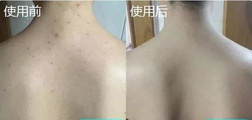 为什么一背都是痘痘