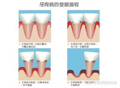 牙齿咬东西酸软无力怎么治疗