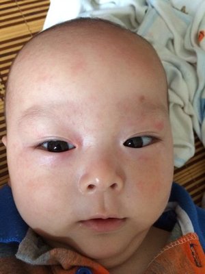 宝宝退烧后脸上起红疹