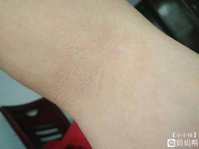 怀孕长癣怎么办
