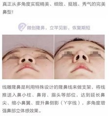 纳米隆鼻多少钱