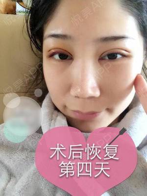 双眼皮术后多久可以洗脸