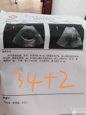足月胎儿股骨长标准