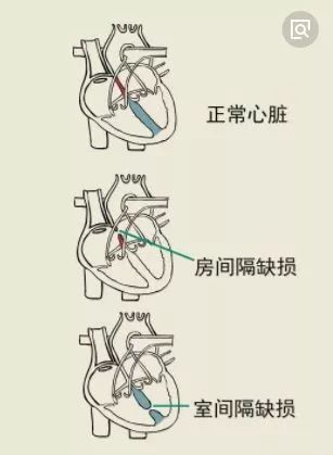 新生儿室间隔缺损