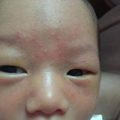 小孩脸上长小红点是怎么回事