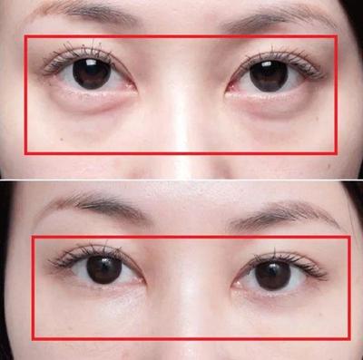 眼霜去黑眼圈有用吗