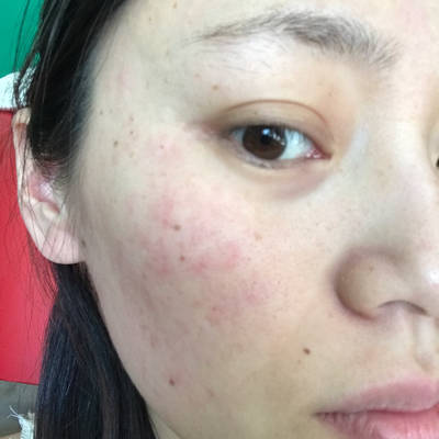 脸上的痘痘变红怎么办