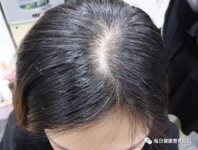 头发中有痘痘怎么回事啊