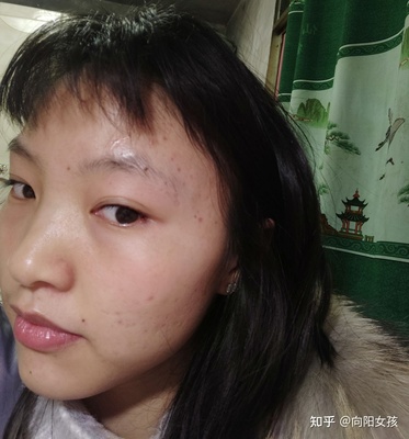 冬天鼻子里痘痘
