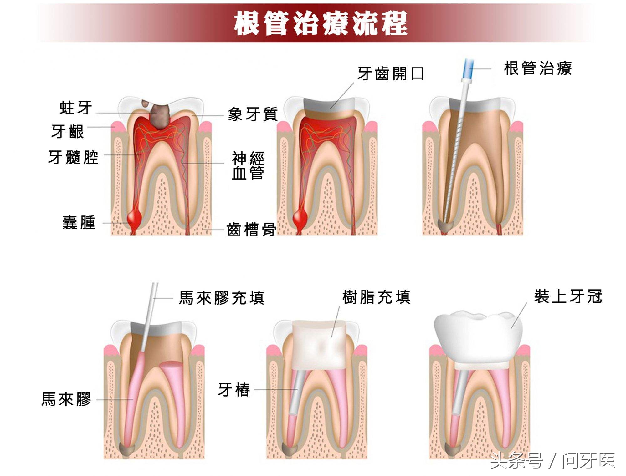 无铍烤瓷牙成本多少钱一颗