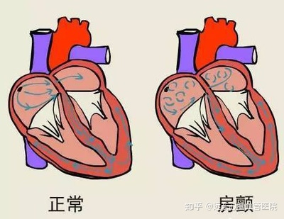 心房颤动怎么治疗