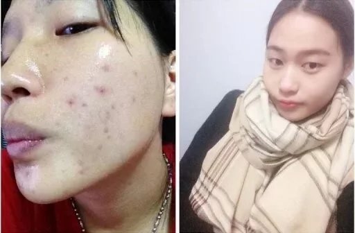 脸上长痘痘吃什么内调