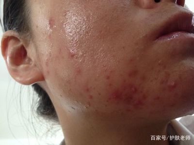 下巴长痘痘与妇科有关系吗