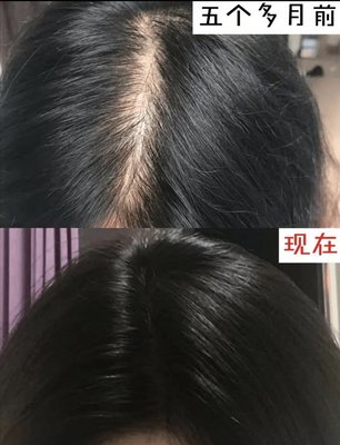 一个月头发能长多少厘米