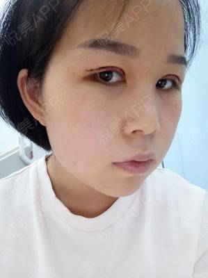 埋线眼睛发痒怎么回事