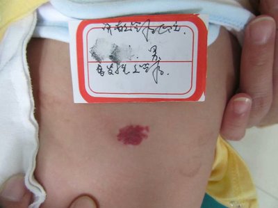 宝宝血管瘤治疗的最好方法