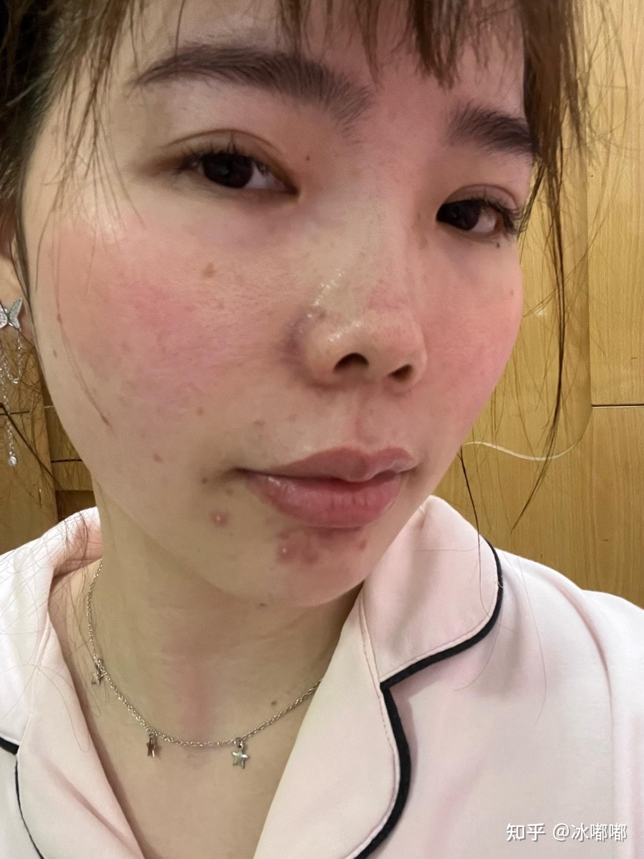 挤痘痘会导致红血丝吗