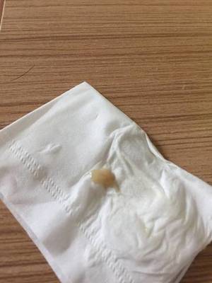 白带有点咖啡色是怎么回事