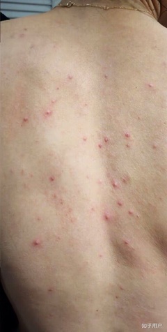 后背全身起痘痘是怎么回事