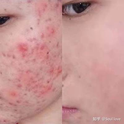 下巴长痘痘与妇科有关系吗