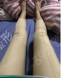 男生瘦臀抽脂