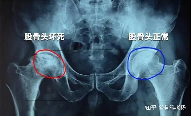 怀孕股骨头疼怎么回事
