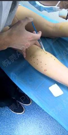 打个瘦腿针
