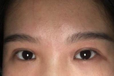 双眼皮什么时候做最好