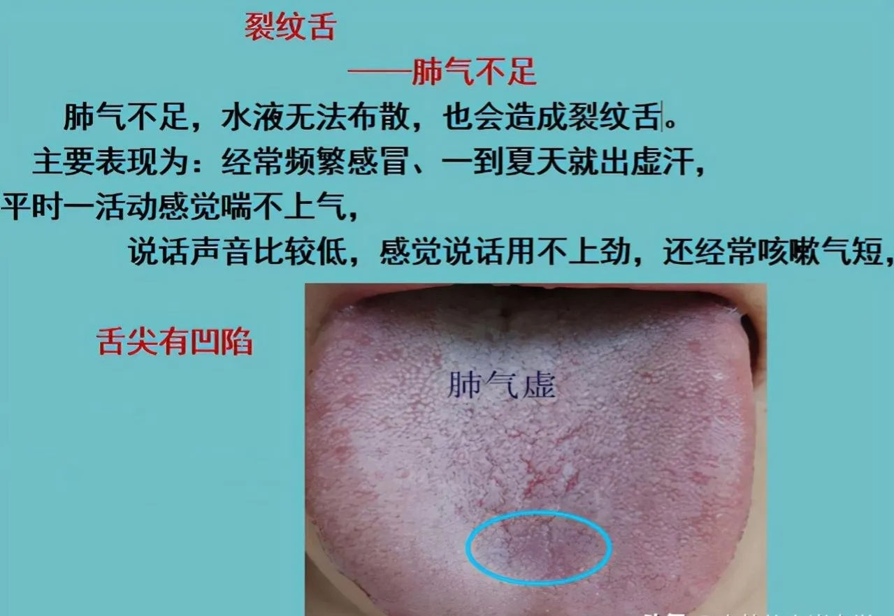 舌尖裂纹是怎么回事
