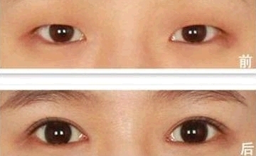 双眼皮太肿