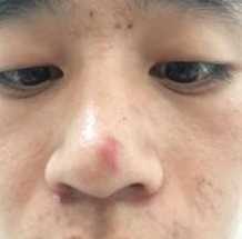 熬夜鼻头长痘痘怎么办